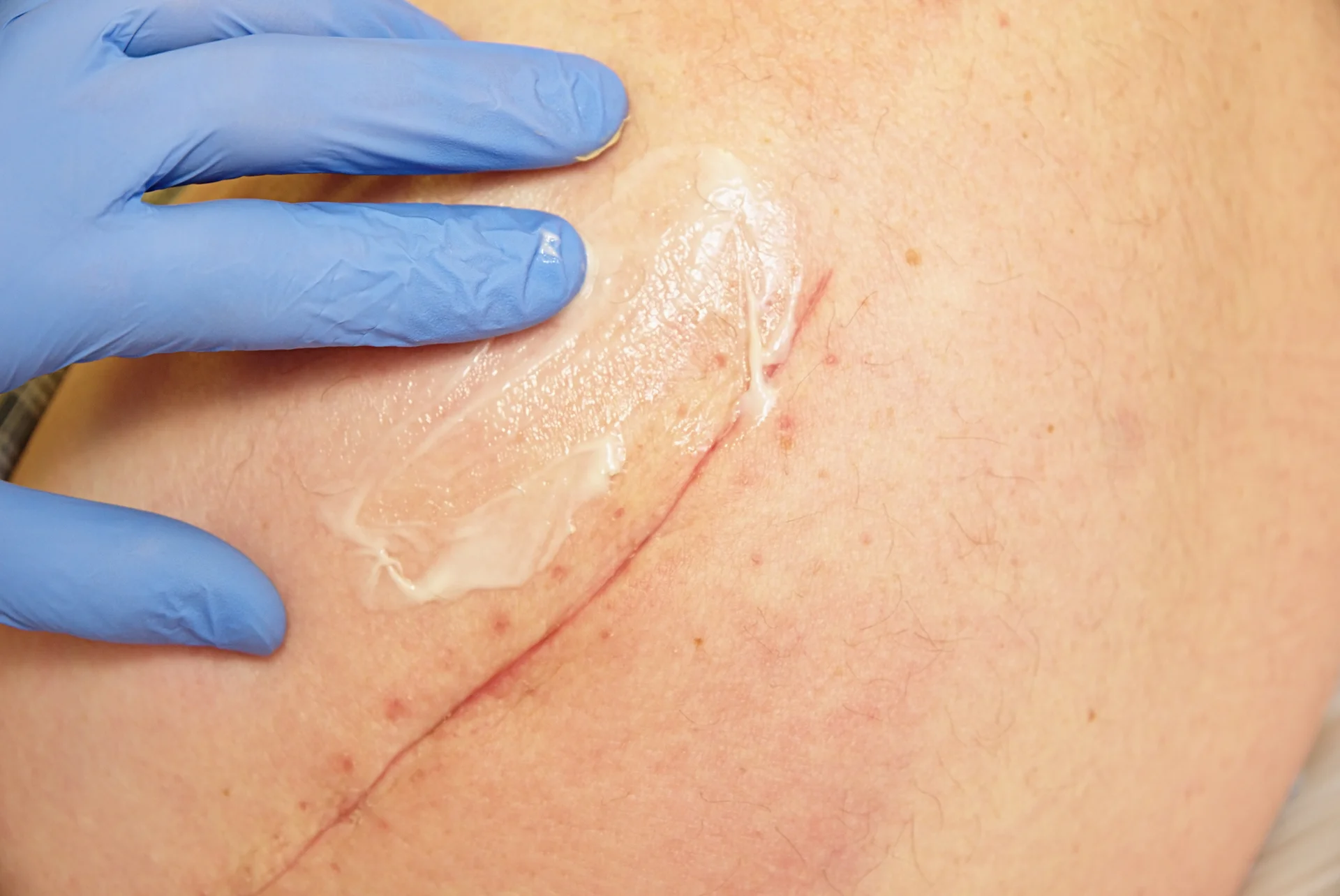 massaging a scar after mohs surgery when can you do it featured